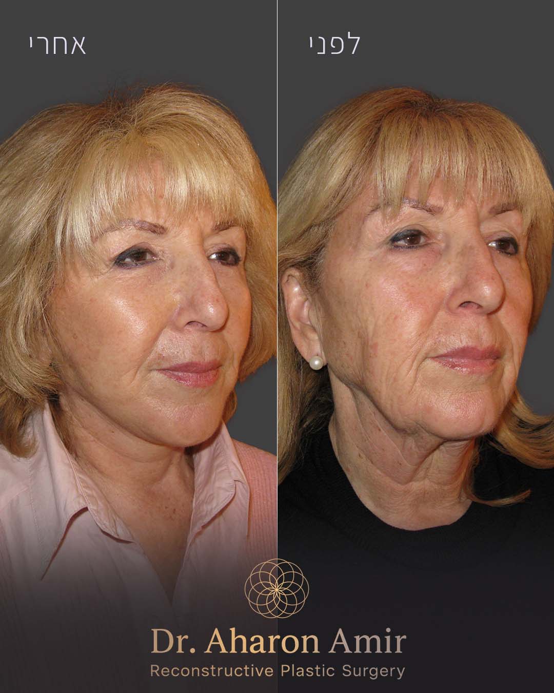 before-after-02