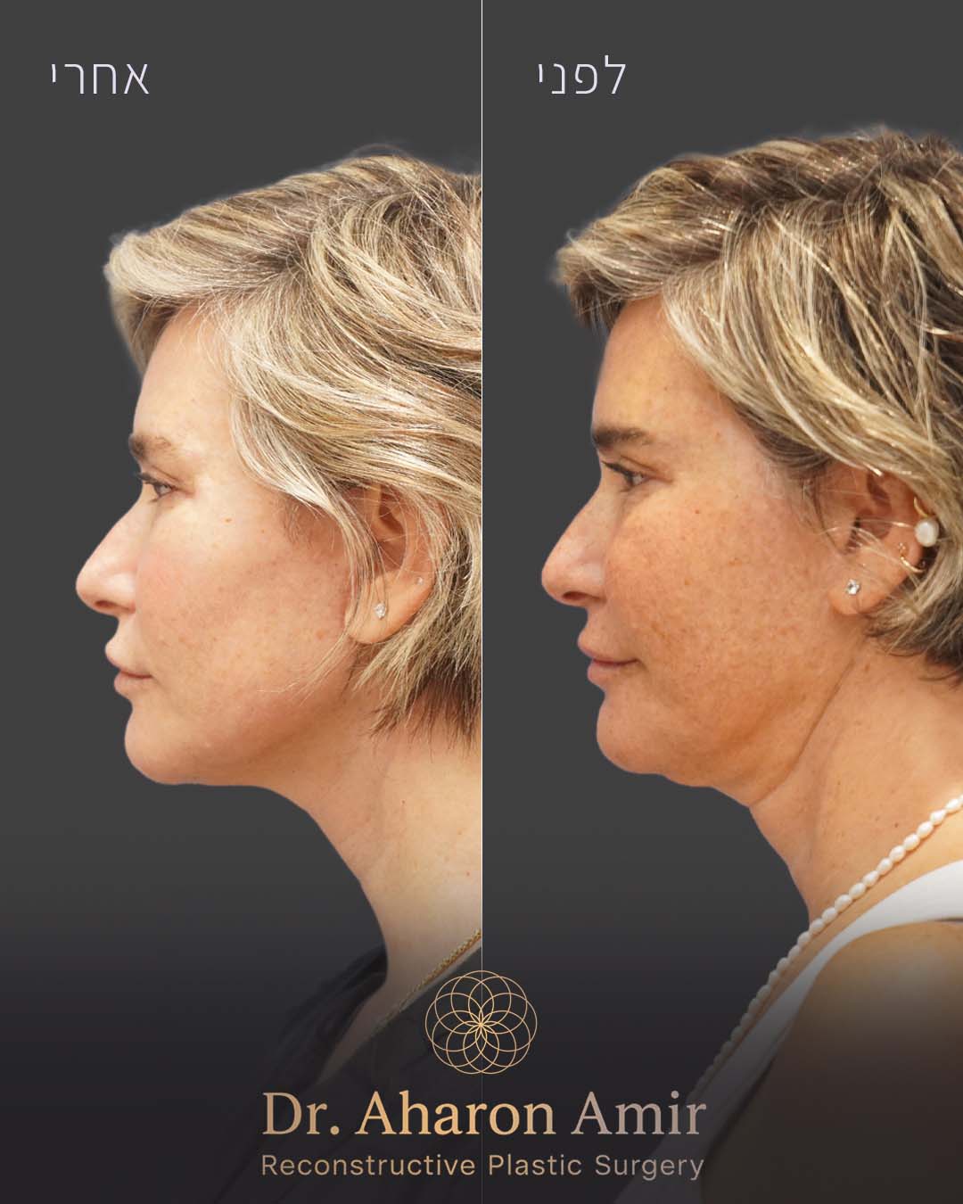 before-after-05
