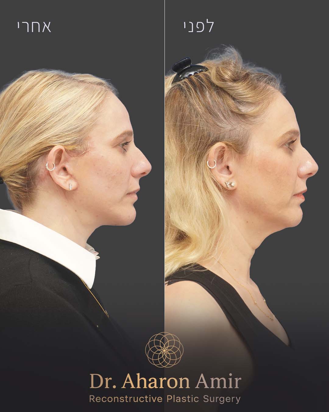before-after-10