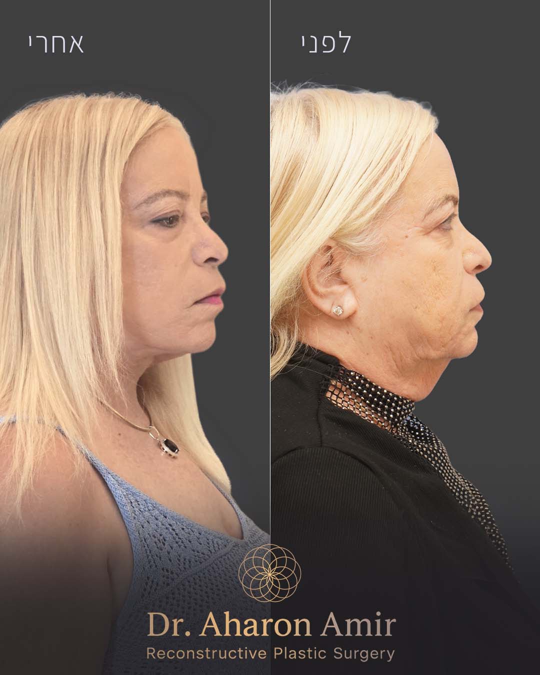 before-after-11